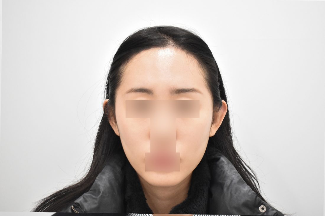 Patient 1 forehead implant after — front view