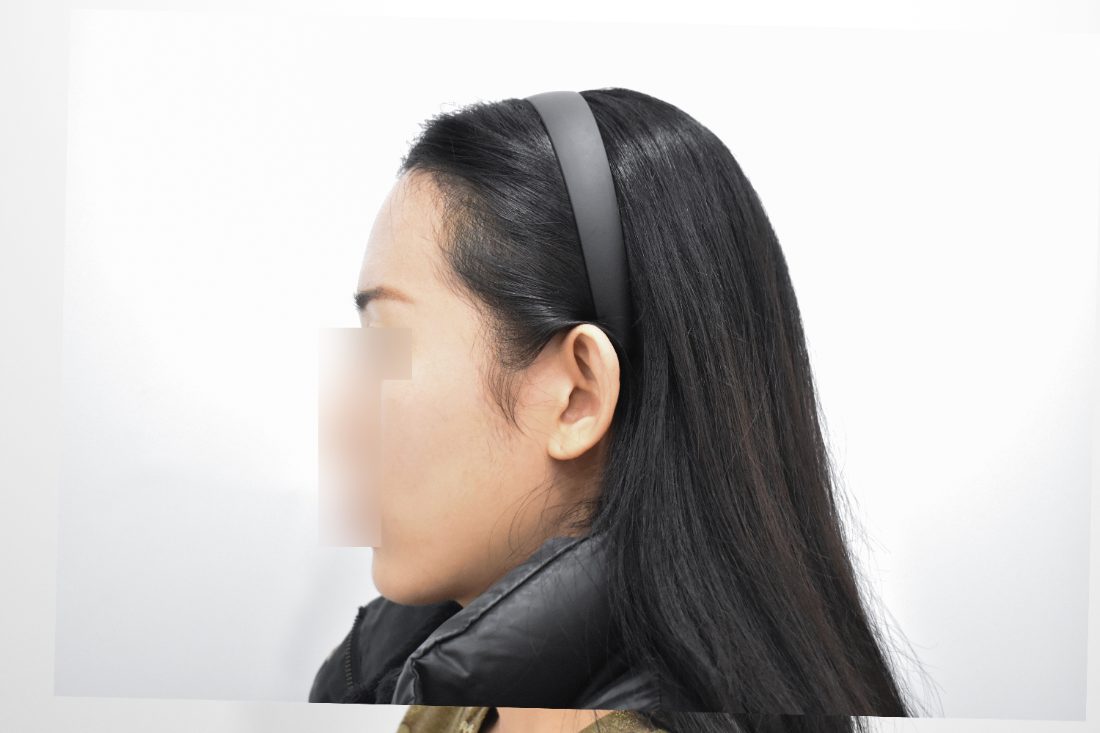 Patient 1 forehead implant after — side view