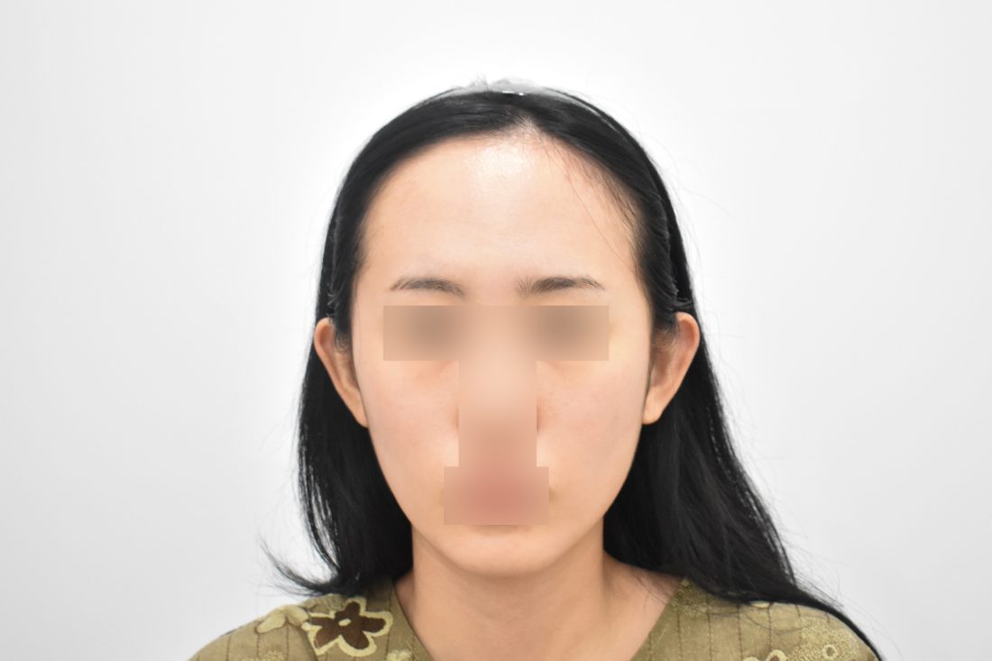 Patient 1 forehead implant before — front view