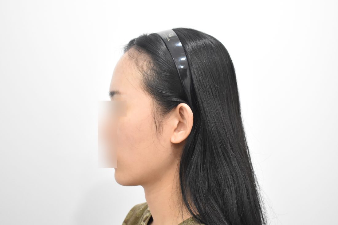 Patient 1 forehead implant before — side view