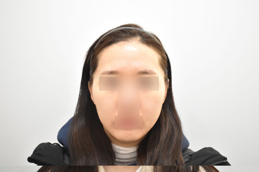 Patient 2 forehead implant after — front view