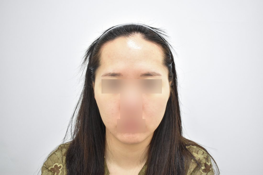 Patient 2 forehead implant before — front view