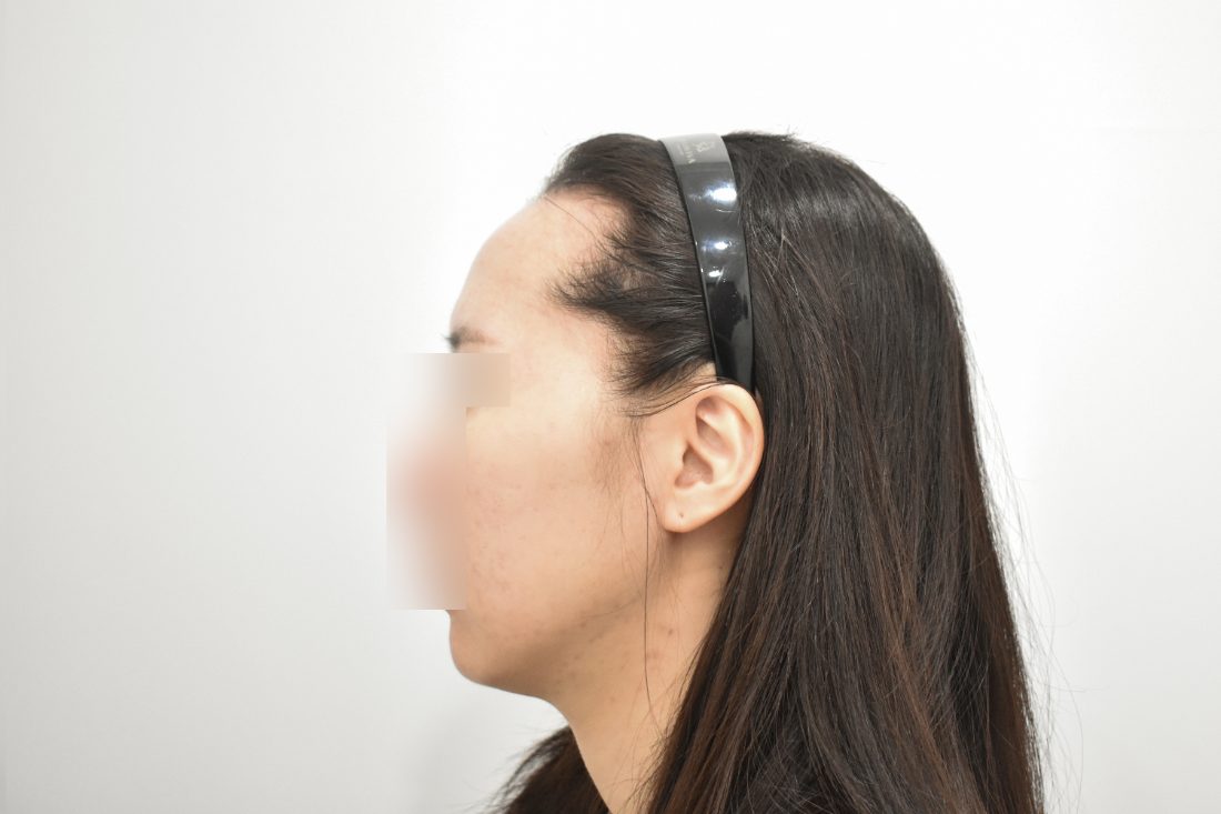 Patient 2 forehead implant before — side view